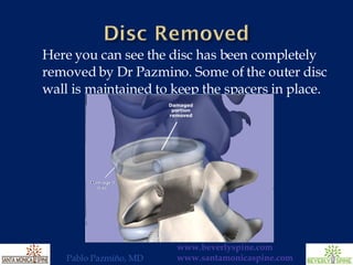Here you can see the disc has been completely removed by Dr Pazmino. Some of the outer disc wall is maintained to keep the spacers in place. 