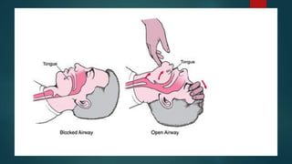 First aid in cardiac arrest | PPTX