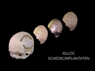 XILLOC
SCHEDELIMPLANTATEN
 