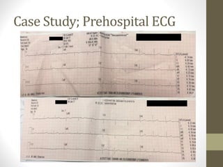 Case Study; Prehospital ECG
 