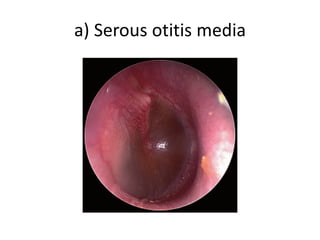a) Serous otitis media
 