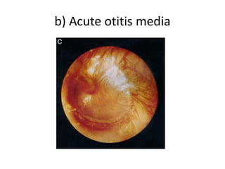 b) Acute otitis media
 