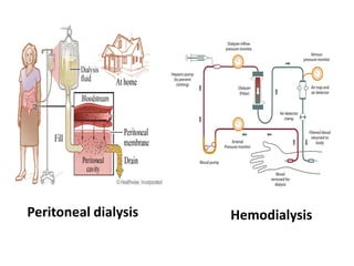 Peritoneal dialysis Hemodialysis
 