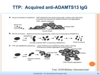 Confidential – For Educational Purposes Only 13
TTP: Acquired anti-ADAMTS13 IgG
 
