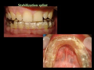 Stabilization splint
 