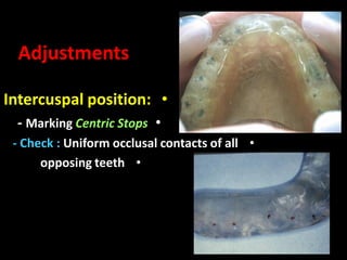 •Intercuspal position:
•- Marking Centric Stops
•- Check : Uniform occlusal contacts of all
•opposing teeth
Adjustments
 