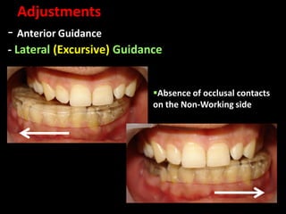 - Anterior Guidance
- Lateral (Excursive) Guidance
Adjustments
Absence of occlusal contacts
on the Non-Working side
 