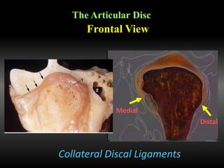 Collateral Discal Ligaments
Frontal View
The Articular Disc
Medial
Distal
 