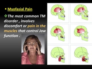  Myofasial Pain
The most common TM
disorder , involves
discomfort or pain in the
muscles that control Jaw
function .
 