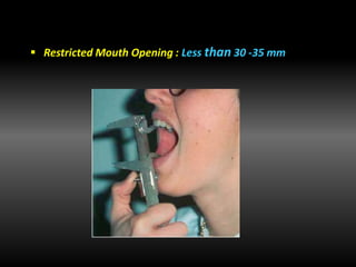  Restricted Mouth Opening : Less than 30 -35 mm
 