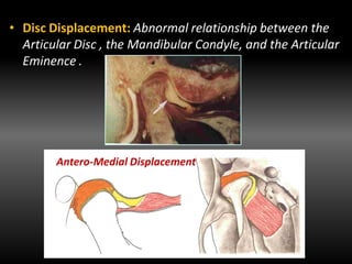 • Disc Displacement: Abnormal relationship between the
Articular Disc , the Mandibular Condyle, and the Articular
Eminence .
Antero-Medial Displacement
 