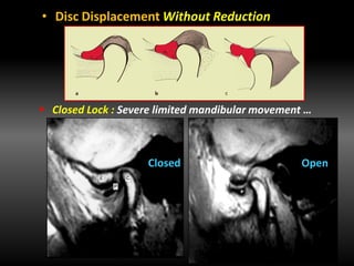 • Disc Displacement Without Reduction
 Closed Lock : Severe limited mandibular movement …
Closed Open
 