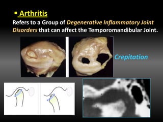  Arthritis
Refers to a Group of Degenerative Inflammatory Joint
Disorders that can affect the Temporomandibular Joint.
Crepitation
 