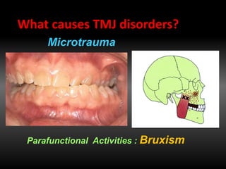 Parafunctional Activities : Bruxism
What causes TMJ disorders?
Microtrauma
 