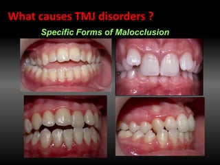 Specific Forms of Malocclusion
What causes TMJ disorders ?
 