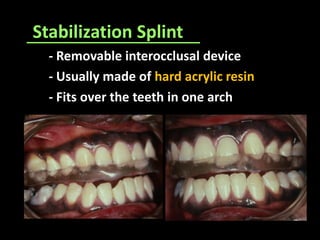Stabilization Splint
- Removable interocclusal device
- Usually made of hard acrylic resin
- Fits over the teeth in one arch
 