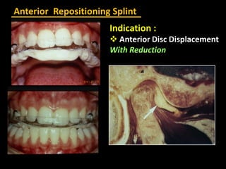 Anterior Repositioning Splint
Indication :
 Anterior Disc Displacement
With Reduction
 