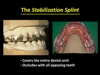 The Stabilization Splint
- Covers the entire dental arch
- Occludes with all opposing teeth
 