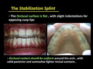 The Stabilization Splint
- The Occlusal surface is flat , with slight indentations for
opposing cusp tips
- Occlusal contact should be uniform around the arch , with
solid posterior and somewhat lighter incisal contacts .
 