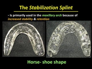 The Stabilization Splint
Horse- shoe shape
- Is primarily used in the maxillary arch because of
increased stability & retention
 