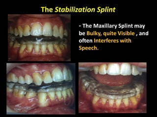 The Stabilization Splint
- The Maxillary Splint may
be Bulky, quite Visible , and
often Interferes with
Speech.
 