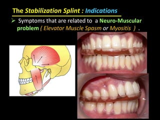The Stabilization Splint : Indications
 Symptoms that are related to a Neuro-Muscular
problem ( Elevator Muscle Spasm or Myositis ) .
 