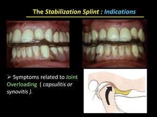  Symptoms related to Joint
Overloading ( capsulitis or
synovitis ).
The Stabilization Splint : Indications
 