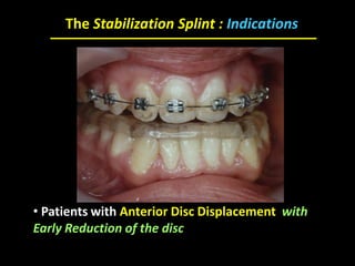 • Patients with Anterior Disc Displacement with
Early Reduction of the disc
The Stabilization Splint : Indications
 