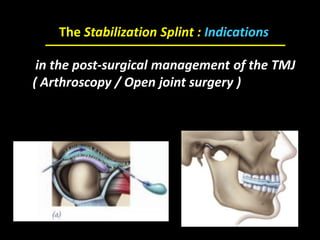 in the post-surgical management of the TMJ
( Arthroscopy / Open joint surgery )
The Stabilization Splint : Indications
 