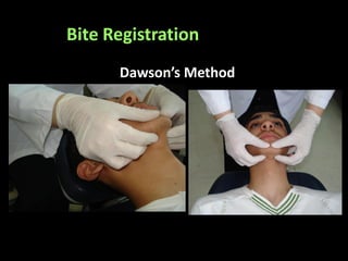 Bite Registration
Dawson’s Method
 