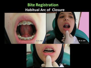 Habitual Arc of Closure
Bite Registration
 