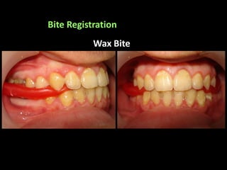 Bite Registration
Wax Bite
 