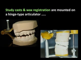 Study casts & wax registration are mounted on
a hinge-type articulator …..
 