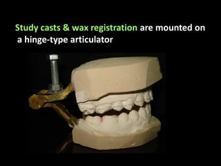 Study casts & wax registration are mounted on
a hinge-type articulator
 
