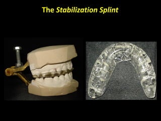 The Stabilization Splint
 