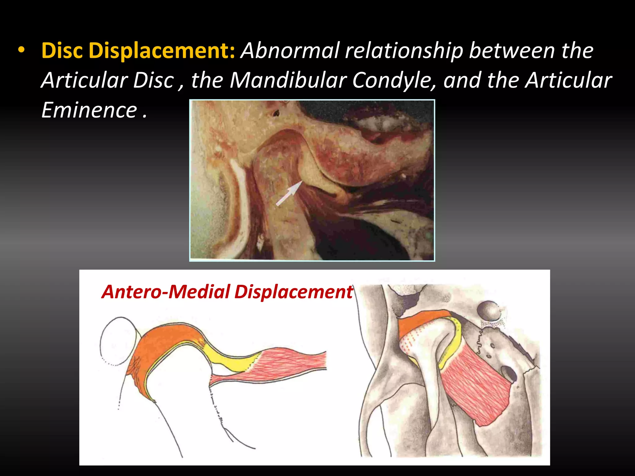 TMDs and occlusal splints therapy | PDF