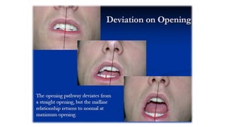TMDs Assesment and management og TMJ disorders, TMJ mobilization | PPTX