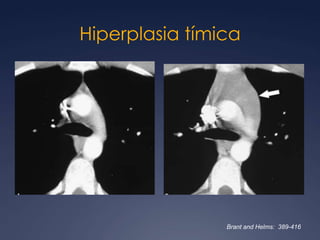 Hiperplasia folicular linfoide o de centros germinales con o sin aumento de la glándula