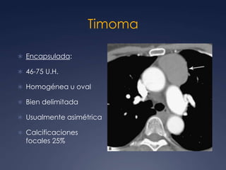 40% Sindrome Paratímico: Miastenia Gravis, aplasia de células rojas, hipergammaglobulinemia