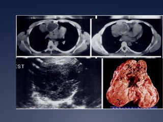 Encapsulado - InvasivoTimoma30%Brant and Helms:  389-416