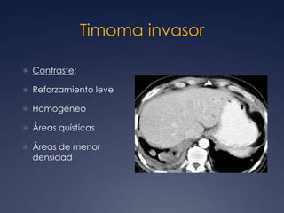 Timoma– Tipos según la OMS