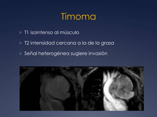 TimomaMasa redondaUnilateralContornos lisos o lobuladosCalcificaciones delgadas, lineales en la periferia.Engrosamiento pleural (unilat, masas o  nodular).