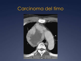 TimomaEncapsulada:46-75 U.H.Homogénea u ovalBien delimitada Usualmente asimétricaCalcificaciones focales 25%