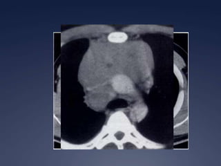 TimomaT1 isointenso al músculo T2 intensidad cercana a la de la grasaSeñal heterogénea sugiere invasión