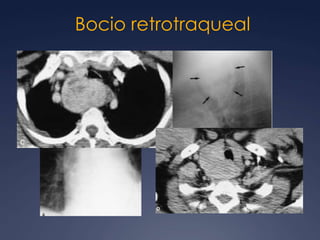 Linfoma tímico40- 50% LH (nodular esclerosante).Aumento de tamaño, a veces con masas solitarias o múltiples. Leve aumento de la atenuación.Es difícil de diferenciar de un timoma.