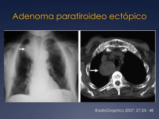 Bocios multinodulares intratorácicos10% de las masas mediastinales75-80% Mediastino anterior20-25% Mediastino posteriorMujeres en la 5ª década 