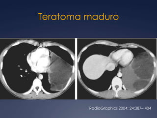 Bocio intratorácicoRadioGraphics 2002; 22:S231–S246