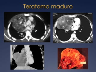 Adenoma paratiroideo ectópicoRadioGraphics 2007; 27:33– 48