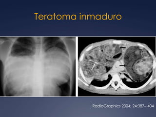 Mas frecuentes en las gónadas