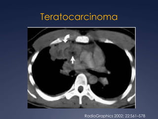 Los extragonadales solo 3%, mas comunes en el mediastino anterior
